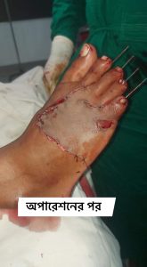 Trauma Operation - Case Id: T1002 || (হাড়ভাঙ্গা অপারেশন)