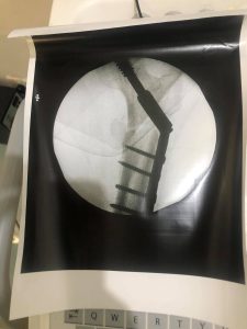 trochanteric fracture - Trauma case -Case Id: T1004